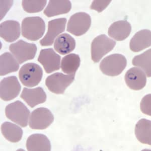 Pf_rings_thinA.jpg Figure G: Rings of <em>P. falciparum</em> in a thin blood smear.