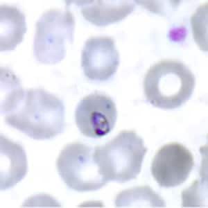 Pm_ring_thinB.jpg Figure C: Ring-form trophozoite of <em>P. malariae</em> in a thin blood smear.