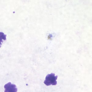 Pm_troph_thickA.jpg Figure A: Trophozoite of <em>P. malariae</em> in a thick blood smear.