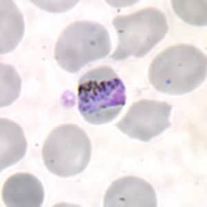 Pm_bandA.jpg Figure A: Band-form trophozoite of <em>P. malariae</em> in a thin blood smear.