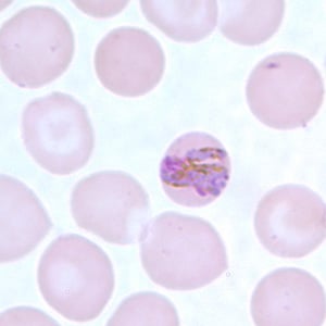 Pm_bandD.jpg Figure D: Band-form trophozoite of <em>P. malariae</em> in a thin blood smear.