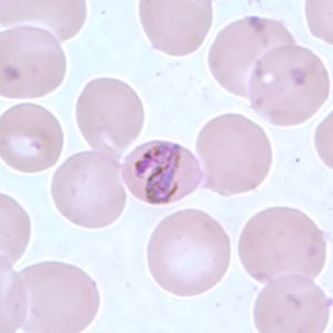 Pm_bandE.jpg Figure E: Band-form trophozoite of <em>P. malariae</em> in a thin blood smear.