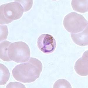 Pm_basketA.jpg Figure A: Basket-form trophozoite of <em>P. malariae</em> in a thin blood smear.