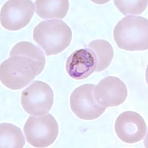 Pm_basketB.jpg Figure B: Basket-form trophozoite of <em>P. malariae</em> in a thin blood smear.