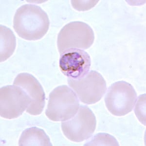 Pm_basketC.jpg Figure C: Basket-form trophozoite of <em>P. malariae</em> in a thin blood smear.