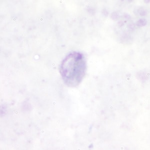 Pm_gametocyte_thickA.jpg Figure A: Gametocyte of <em>P. malariae</em> in a thick blood smear.