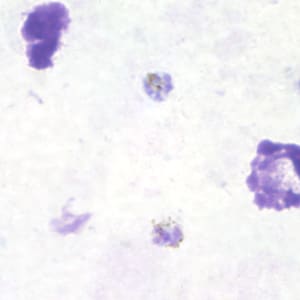 Pm_gametocyte_thickB.jpg Figure B: Gametocyte of <em>P. malariae</em> in a thick blood smear.