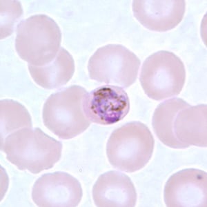 Pm_gametocyte_thinD.jpg Figure F: Developing gametocyte of <em>P. malariae</em> in a thin blood smear.