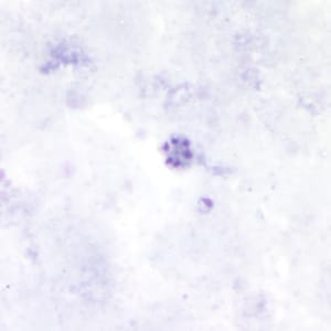 Pm_schizont_thickA.jpg Figure A: Schizont of <em>P. malariae</em> in a thick blood smear.