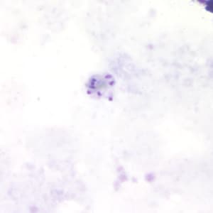 Pm_schizont_thickB.jpg Figure B: Schizont of <em>P. malariae</em> in a thick blood smear.