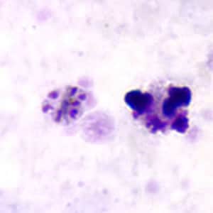Pm_schizont_thickD.jpg Figure D: Schizont of <em>P. malariae</em> in a thick blood smear.
