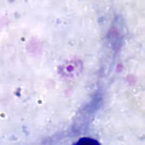 Po_rings_thickA.jpg Figure A: Ring-form trophozoite of <em>P. ovale</em> in a thick blood smear.