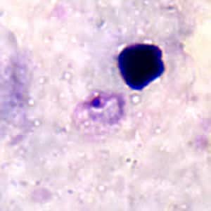 Po_rings_thickB.jpg Figure B: Ring-form trophozoite of <em>P. ovale<em> in a thick blood smear.