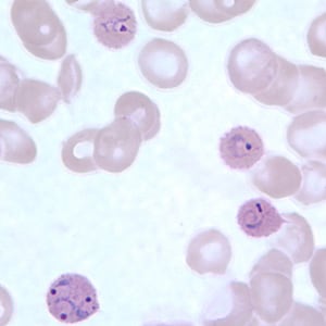 Po_rings_thinC.jpg Figure E: Ring-form trophozoites of <em>P. ovale</em> in a thin blood smear. Note the multiply-infected RBC in this image.