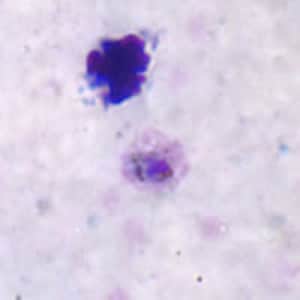 Po_troph_thickA.jpg Figure A: Trophozoite of <em>P. ovale</em> in a thick blood smear.