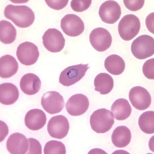 Po_troph_thinA.jpg Figure B: Trophozoite of <em>P. ovale</em> in a thin blood smear. Note the fimbriation.
