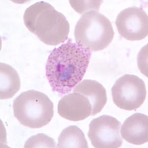 Po_troph_thinB.jpg Figure C: Trophozoite of <em>P. ovale</em> in a thin blood smear. Note the fimbriation and Schüffner's dots.