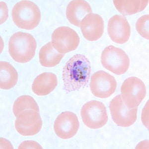 Po_troph_thinC.jpg Figure D: Trophozoite of <em>P. ovale</em> in a thin blood smear. Note the fimbriation and Schüffner's dots.