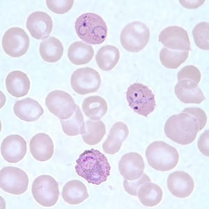 Po_troph_thinE.jpg Figure F: Infected RBCs showing developing (lower) and ring-form (upper two) trophozoites of <em.P. ovale</em> in a thin blood smear.