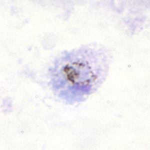 Po_gametocyte_thickA.jpg Figure A: Gametocyte of <em>P. ovale</em> in a thick blood smear.