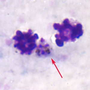 Po_gametocyte_thickB.jpg Figure B: Gametocyte of <em>P. ovale</em> (red arrow) nestled between two white blood cells in a thick blood smear.