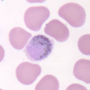 Po_gametocyte_thinB.jpg Figure D: Macrogametocyte of <em>P. ovale</em> in a thin blood smear. Note the fimbriation.