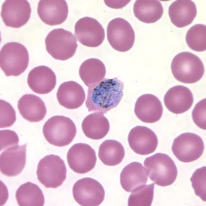 Po_gametocyte_thinC.jpg Figure E: Macrogametocyte of <em>P. ovale</em> in a thin blood smear. Note the fimbriation.