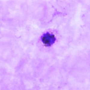 Po_schizont_thickA.jpg Figure A: Schizont of <em>P. ovale</em> in a thick blood smear.