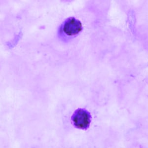 Po_schizont_thickB.jpg Figure B: Schizonts of <em>P. ovale</em> in a thick blood smear.