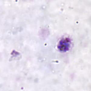 Po_schizont_thickC.jpg Figure C: Schizont of <em>P. ovale</em> in a thick blood smear.