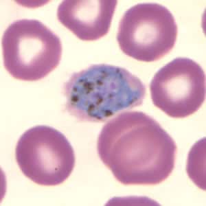 Po_schizont_thinA.jpg Figure D: Schizont of <em>P. ovale</em> in a thin blood smear. Notice the fimbriation.