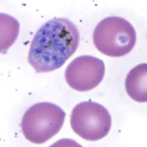 Po_schizont_thinB.jpg Figure E: Schizont of <em>P. ovale</em> in a thin blood smear. Notice the fimbriation.