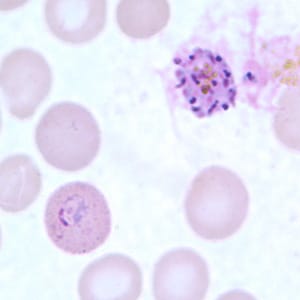 Po_schizont_thinD.jpg Figure G: Schizont (upper right) and ring-form trophozoite (lower left) of <em>P. ovale</em> in a thin blood smear.