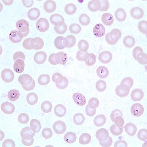 Pf_MaurersA.jpg Figure A: Ring-form trophozoites of <em>P. falciparum</em> in a thin blood smear, exhibiting Maurer's clefts.
