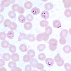 Pf_MaurersB.jpg Figure B: Ring-form trophozoites of <em>P. falciparum</em> in a thin blood smear, exhibiting Maurer's clefts.