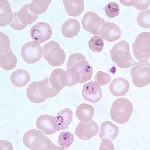 Pf_MaurersD.jpg Figure D: Ring-form trophozoites of <em>P. falciparum</em> in a thin blood smear, exhibiting Maurer's clefts.