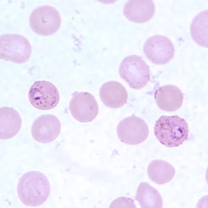 Pf_MaurersE.jpg Figure E: Ring-form trophozoites of <em>P. falciparum</em> in a thin blood smear, exhibiting Maurer's clefts.