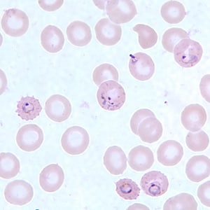 Pf_MaurersF.jpg Figure F: Ring-form trophozoites of <em>P. falciparum</em> in a thin blood smear, exhibiting Maurer's clefts.