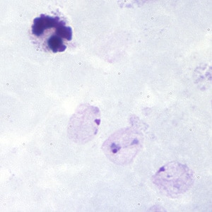 Pv_rings_thickB.jpg Figure B: Ring-form trophozoites of <em>P. vivax</em> in a thick blood smear.