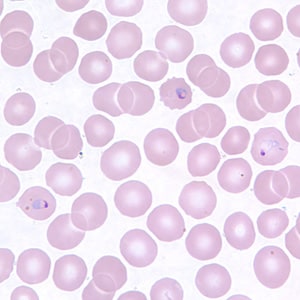 Pv_rings_thinC.jpg Figure E: Ring-form trophozoites of <em>P. vivax</em> in a thin blood smear.