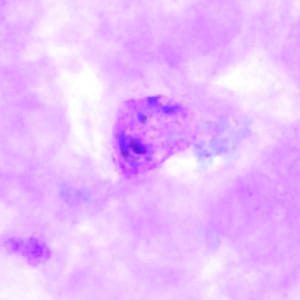 Pv_troph_thickA.jpg Figure A: Trophozoite of <em>P. vivax</em> in a thick blood smear.