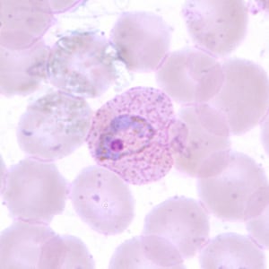Pv_troph_thinA.jpg Figure B: Trophozoite of <em>P. vivax</em> in a thin blood smear. Note the amoeboid appearance, Schüffner's dots and enlarged infected RBCs.