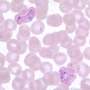 Pv_troph_thinB.jpg Figure C: Trophozoites of <em>P. vivax</em> in a thin blood smear. Note the amoeboid appearance, Schüffner's dots and enlarged infected RBCs.