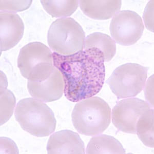 Pv_troph_thinC.jpg Figure D: Trophozoite of <em>P. vivax</em> in a thin blood smear. Note the amoeboid appearance, Schüffner's dots and enlarged infected RBCs.