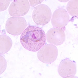 Pv_troph_thinD.jpg Figure E: Trophozoite of <em>P. vivax</em> in a thin blood smear. Note the amoeboid appearance, Schüffner's dots and enlarged infected RBCs.