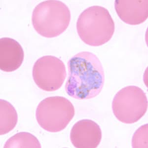 Pv_troph_thinE.jpg Figure F: Trophozoite of <em>P. vivax</em> in a thin blood smear. The infected RBCs are also noticeably larger than the uninfected RBCs.