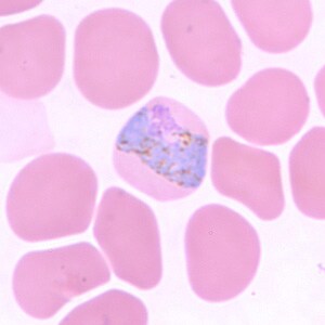 Pv_troph_thinF.jpg Figure G: Trophozoite of <em>P. vivax</em> in a thin blood smear. Note the band-like appearance of the trophozoite in this figure that may be mistaken for a band-form trophozoite of P. malariae. Note, however, the fine, light brown pigment that is distributed throughout the cytoplasm (pigment in P. malariae is usually darker and coarser and distributed on the periphery of the cytoplasm). The infected RBCs are also noticeably larger than the uninfected RBCs.