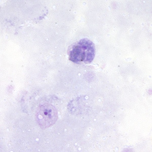 Pv_gametocyte_thickA.jpg Figure A: Gametocyte (upper) and trophozoite (lower) of <em>P. vivax</em> in a thick blood smear.