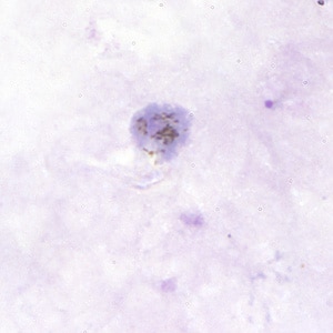 Pv_gametocyte_thickB.jpg Figure B: Gametocyte of <em>P. vivax</em> in a thick blood smear.