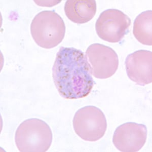 Pv_gametocyte_thinC.jpg Figure E: Macrogametocyte of <em>P. vivax</em> in a thin blood smear. Note the enlargement of the gametocytes compared to uninfected RBCs.